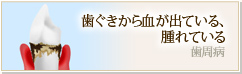 歯ぐきから血が出ている、腫れている 歯周病