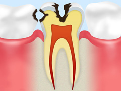 C2【象牙質のむし歯】