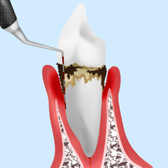 歯周ポケット診査